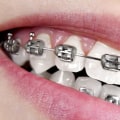 Can insurance cover braces?